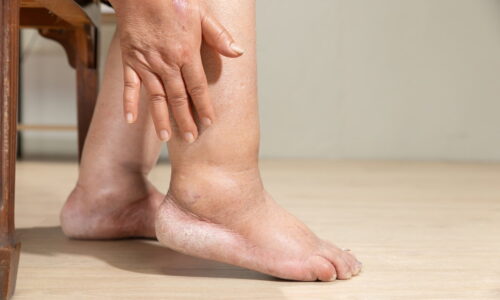 Linfedema: o que é, sintomas, causas e tratamento (tem cura?)