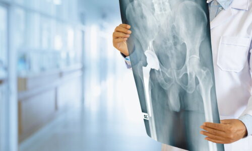 Artroplastia de quadril: quando é indicada, cuidados e dúvidas comuns