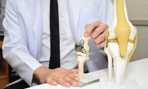 Prótese de joelho: o que é, tipos e como é feita a cirurgia