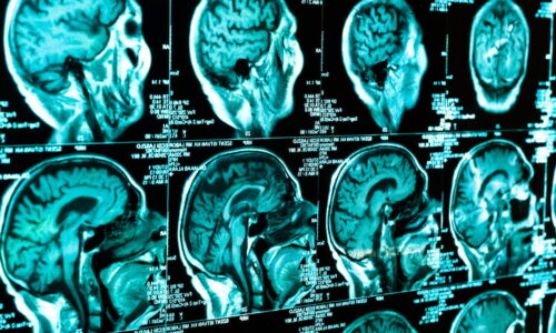 Traumatismo craniano: o que é, sintomas, tratamento e sequelas
